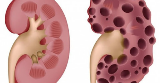 suy thận ở người